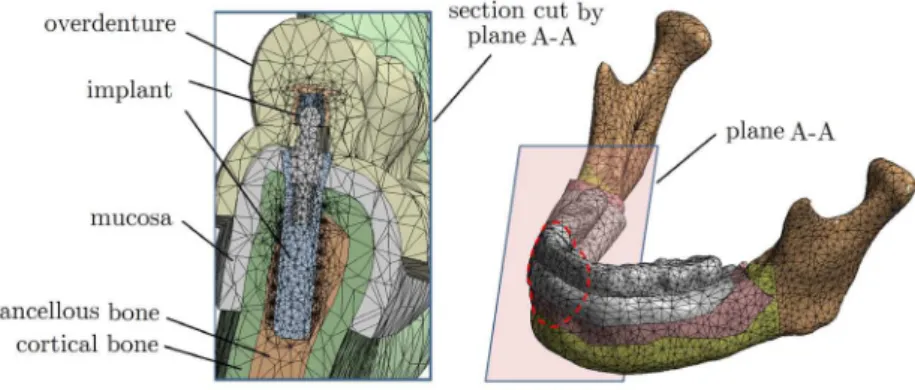 Figure 4: Meshed model of the mandible and its overdenture with an implant. 