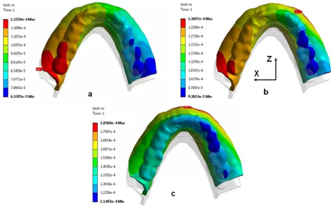 Figure 6: Lateral overdenture deformation along z axis for: a) ball,   b) bar-clip and c) bar-ball designs (all dimensions in meter)