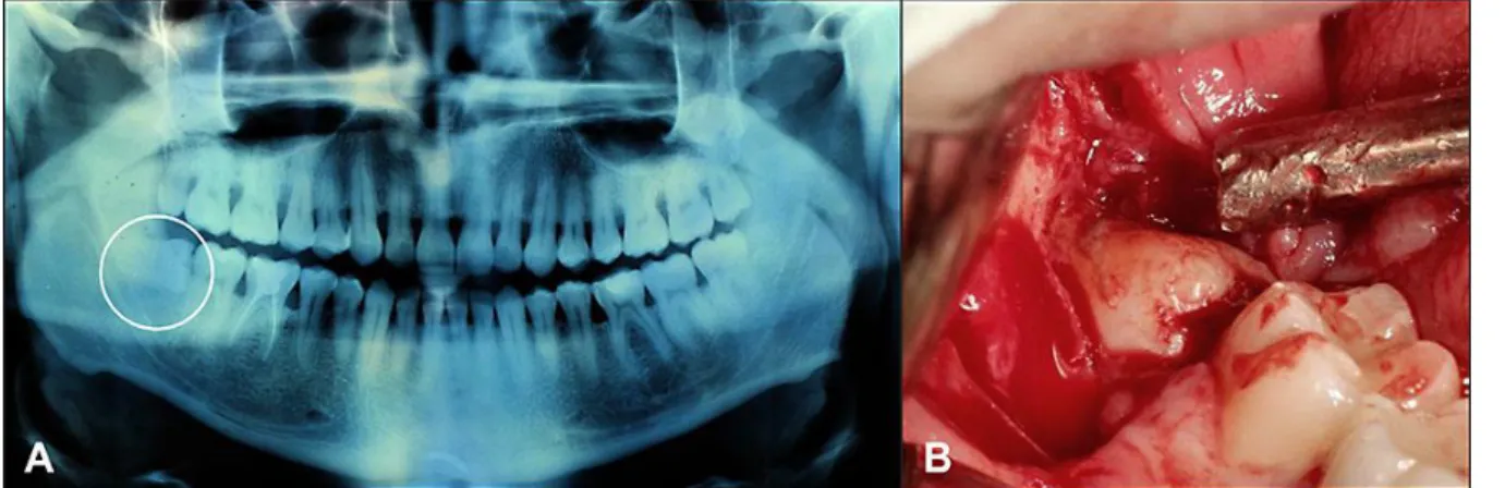 Figura  4. Classificação  do  dente  (A)  e  predição  da  exodontia  complicada  (B)  (Spiotto, Juodzbalys, Daugela, 2013) 