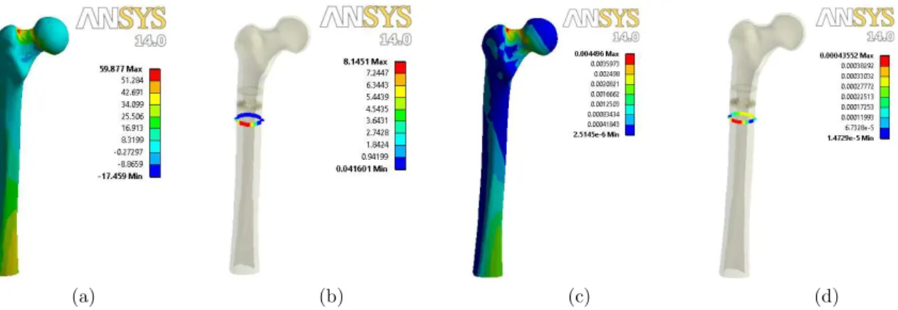 Figure 4: Orthotropic cortical tissue: Maximum principal stresses distribution at: (a) external surface  and (b) path; Maximum principal strain distribution at: (c) external surface and (d) path