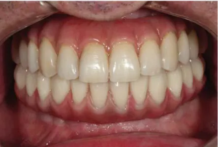 Figura  1  -  Fotografia  intra-oral  representativa  de  um  paciente  com  prótese  fixa  total  implantossuportada  superior  e  inferior  (Maló  et  al.,  2011)