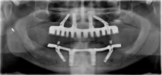 Figura  2  –  Ortopantomografia  de  um  paciente  com  prótese  total  implantossuportada  superior e inferior