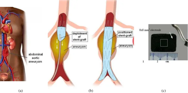 Figure 10: (a) Illustration of an aneurysm localized in the aorta. (b) Artwork showing the endovascular aneurysm repair  concept, using stent-grafts