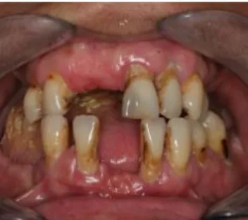 Fig. 4 - Fotografia intra oral da paciente com mordida em relação cêntrica. 