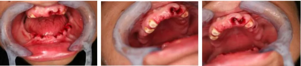 Fig. 10 - Imagens intra orais após extracções dentárias e corte dos dentes a nível justagengival