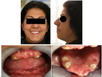 Fig. 14 - Fotografias frontais e intra orais da paciente após uma semana. 