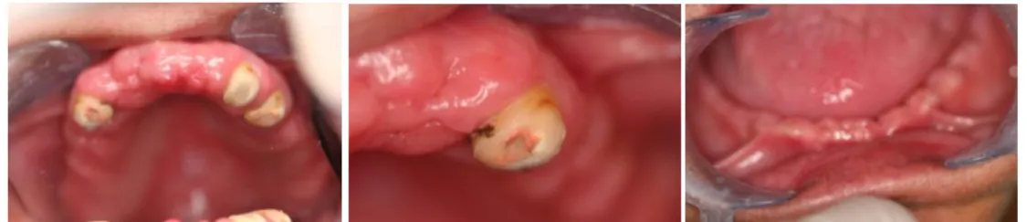 Fig. 18 - Fotografias intra-orais onde é visível uma ligeira extrusão dentária. 