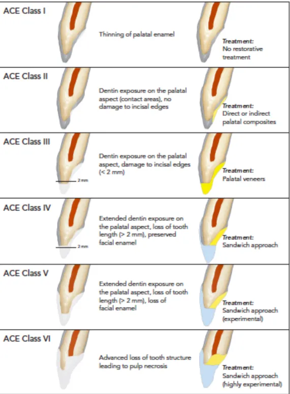 Figura 3 – Classificação ACE (Anterior Clinical Erosive). Retirado e adaptado de Vailati et  al., 2010