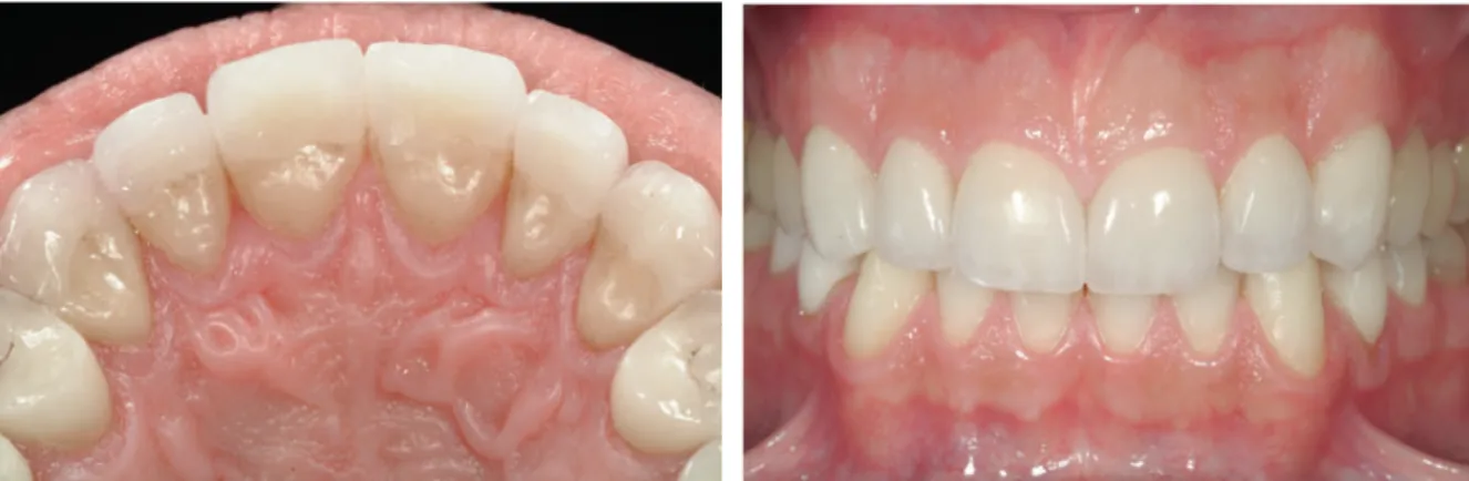 Figura 5 e 6 – Reabilitação dentária com onlays palatinos e facetas cerâmicas vestibulares nos  dentes anteriores maxilares