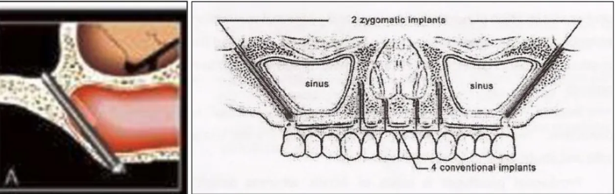 Figura 6A-Técnica convencional de colocação de implantes zigomáticos. 6B-Colocação  de dois implantes zigomáticos e quatro implantes convencionais na pré-maxila
