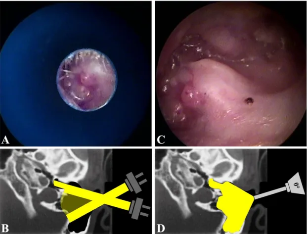 Figura  2.  Otoscopia  de  cavidade  aberta  em  orelha  esquerda  com  microscópio  (imagens à esquerda) e com endoscópio (imagens à direita)