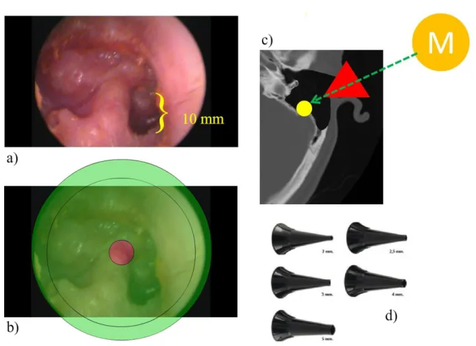 Figura  3.  a)  Visão  endoscópica  de  pós-operatório  tardio  de  mastoidectomia  com  cavidade  aberta  em  orelha  direita