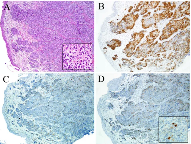 Table 1 Head and neck malignancies that may exhibit rhabdomyoblastic