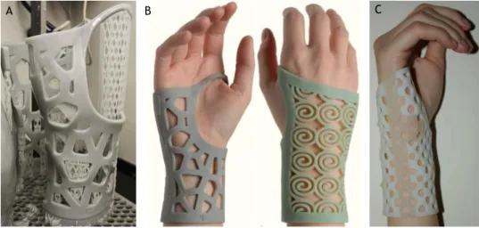 Figure 1.2 – Wrist orthoses developed by Paterson et al. A: wrist orthosis, SL build with showing support  structures [2]