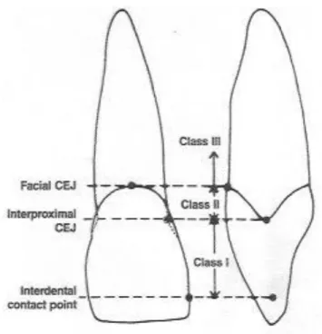 Figura 2: Ilustração representativa do sistema de classificação para a perda de  altura papilar (adaptado de Nordland e Tarnow, 1998) 