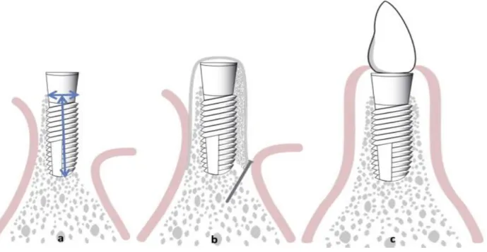 Fig. 4- Inadequada altura e largura óssea para sucesso do tratamento (a); colocação de membrana e  enxerto ósseo para promover neoformação óssea (b); Após novo osso formado coloca-se a prótese  sobre o implante (c) (Rakhmatia et al., 2013)