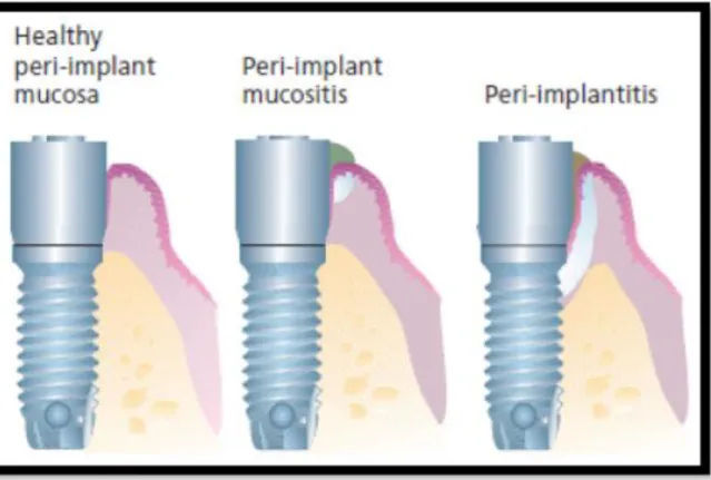 Fig.  5-  Esquema  ilustrativo  de  mucosa  periimplantar  saudável,  mucosite  periimplantar  e  periimplantite (Lindhe et al., 2008) 