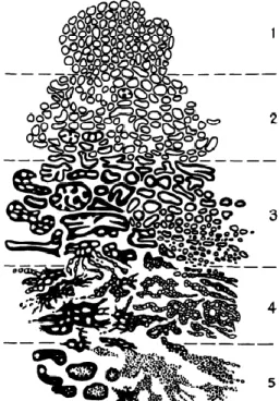 Figura 1. Escala de Gleason-   Figura adaptada de (GLEASON, 1992)  