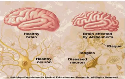 Figure 1.1:  Comparison of a healthy brain and a brain affected by AD, showing senile plaques and  NFTs tangles leading to cortex atrophy