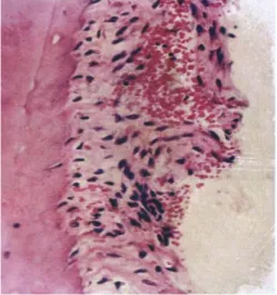 Figura 2 – L.P danificado e coberto de fibroblastos viáveis (Retirado de Trope, 2011)