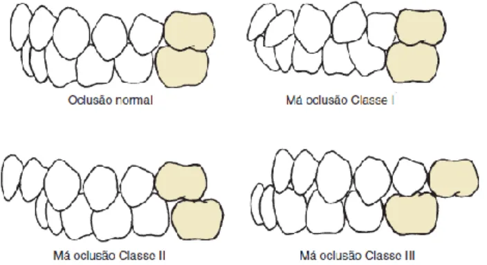 Figura 2: Classificação de má-oclusão de Angle (Adaptado de Proffit et al., 2012) 