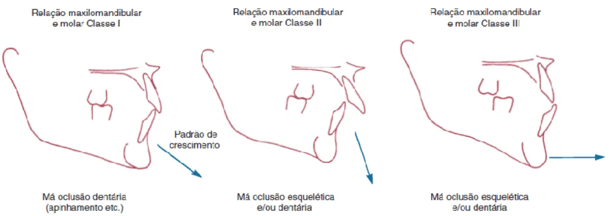 Figura 3:A classificação de Angle descrição de quatro caracteristícas: o tipo de má oclusão, a relação  molar, a relação maxilomandibular e o padrão de crescimento