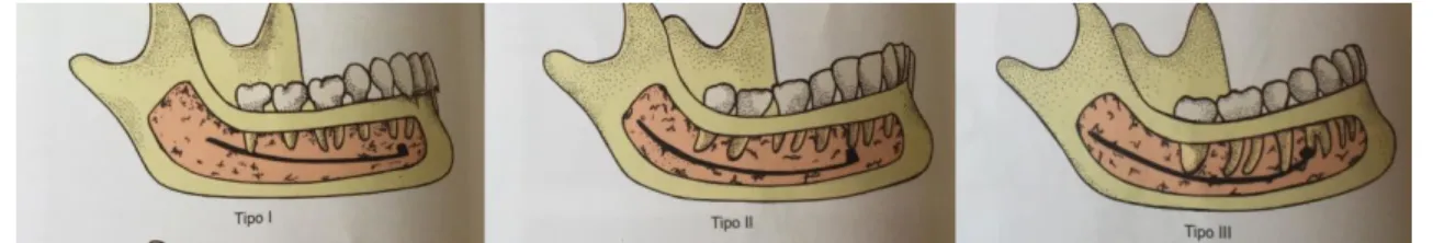 Figura 1- Tipos de relações dos alvéolos inferiores com o canal mandibular, Teixeira L; Reher P; Reher  V