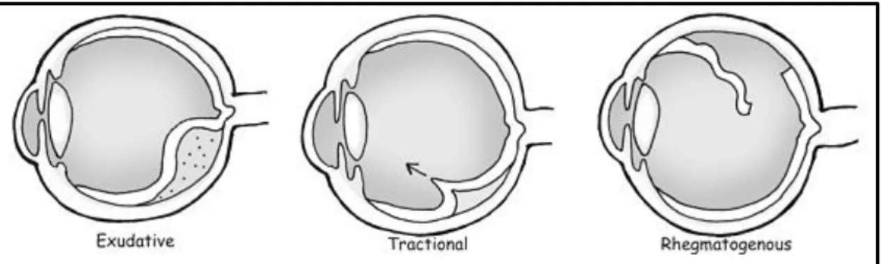 Figure 5 - Types of retinal detachment (adapted from [10]).