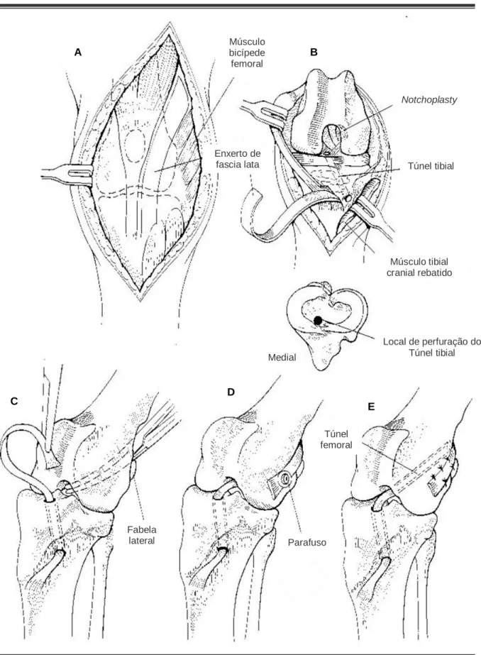 Figura 12  –  Técnica intra-capsular com enxerto constituído pelo terço lateral do ligamento  patelar e fascia lata 