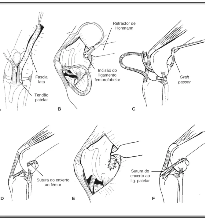 Figura 13 –  Técnica OTT (Hulse et al, 1980) com enxerto constituído pelo terço lateral do  ligamento patelar e fascia lata 