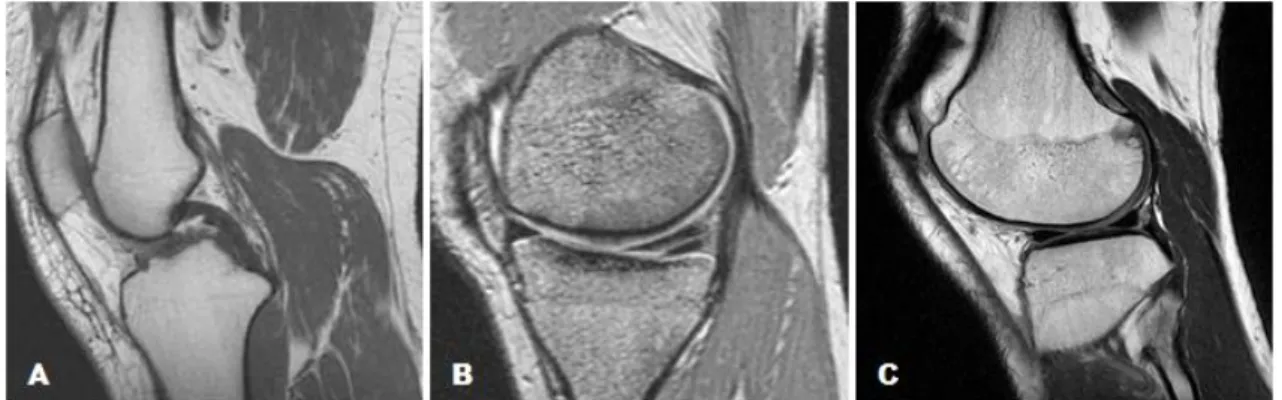 Figure 8 - Sagittal images of the knee. (A) T 1 -weight image. (B) T 2 -weight image. (C) PD-weight image