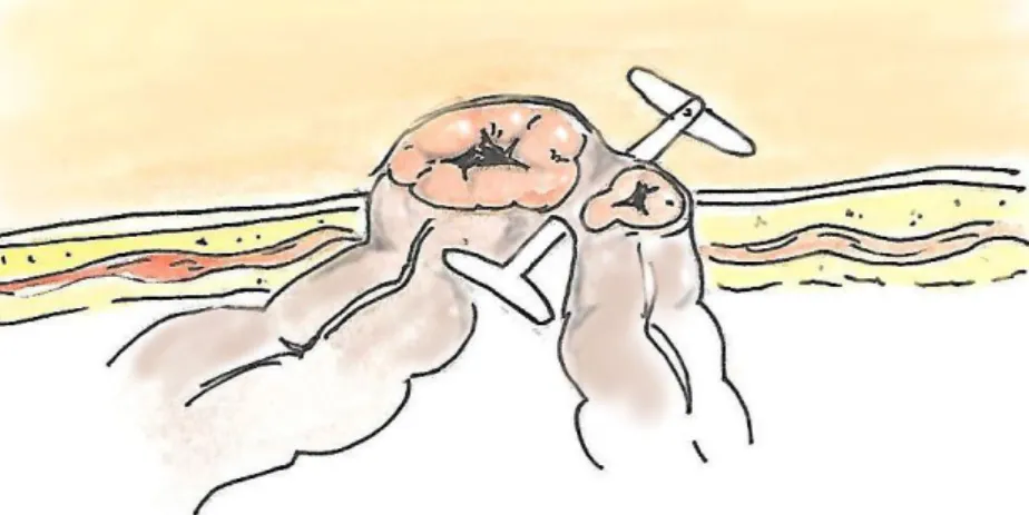 Figura 2- Colostomia em Ansa 39    