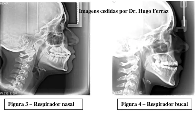 Figura 3 – Respirador nasal                                 Figura 4 – Respirador bucalImagens cedidas por Dr