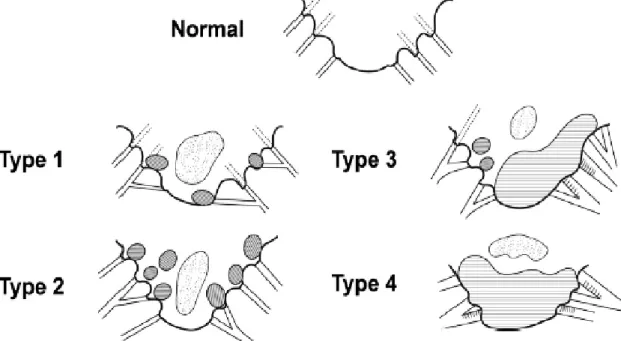 Figure 5: Four grade classification of mitral valve lesions according to Whitney. (Reproduced with  permission from Dr