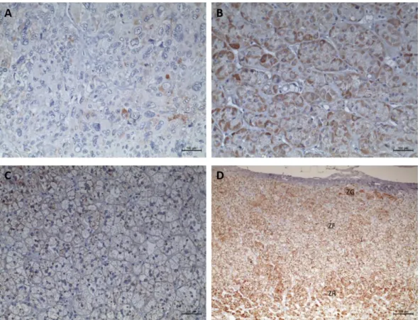 Figure 25 - Immunohistochemistry staining for StAR (Scale = 50 µm). A- Adrenocortical carcinoma; B-  Adrenocortical adenoma with Cushing syndrome; C- Non-functioning adrenocortical adenoma and D-  Normal adrenal gland