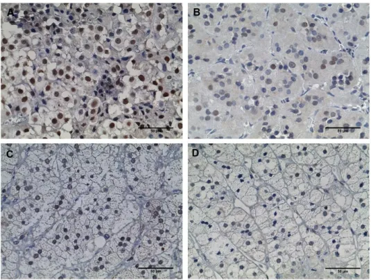 Figure 12 -  Immunohistochemistry staining  of p27 (Scale  = 50 µm). A- Adrenocortical carcinoma; B-  Adrenocortical adenoma with Cushing syndrome; C- Non-functioning adrenocortical adenoma and D-  Normal adrenal gland