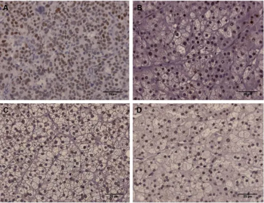 Figure  13-  Immunohistochemistry  staining  of  p53  (Scale  =  50  µm).  A-  Adrenocortical  carcinoma;  B-  Adrenocortical adenoma with Cushing syndrome; C- Non-functioning adrenocortical adenoma and D-  Normal adrenal gland