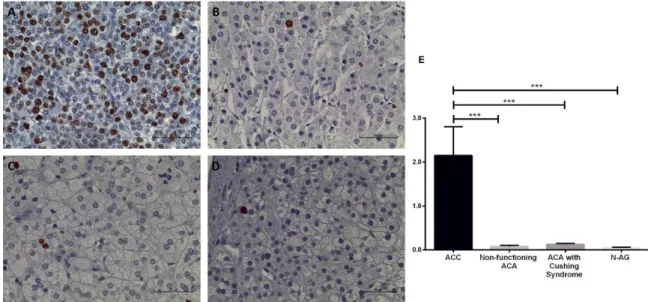 Figure 19 - Immunohistochemistry staining of Ki-67 (Scale = 50 µm). A- Adrenocortical carcinoma; B-  Adrenocortical  adenoma  with  Cushing  syndrome;  C-  Non-functioning  adrenocortical  adenoma;  D-  Normal  adrenal  gland,  and  E-  Graphic  representa