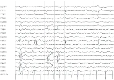 Figura 1.9 – Electroencefalograma com pontas centro-temporais de uma criança com epilepsia benigna  infantil (Pontas registadas ao longo das regiões centrais e temporais)