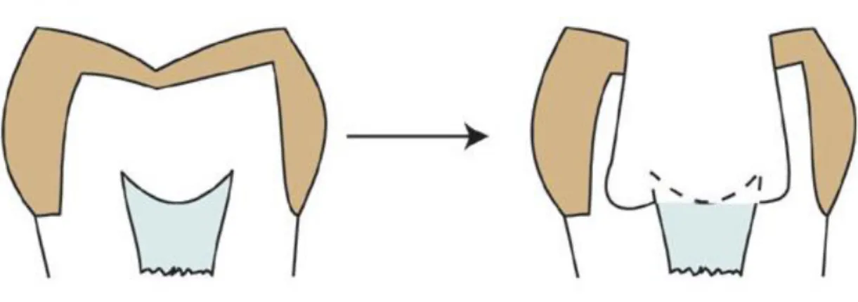 Figura 1 Remoção excessiva de tecido dentário durante a preparação da cavidade de acesso enfraquece as  paredes verticais da preparação