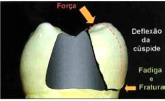 Figura 2 Distribuição das forças mastigatórias no dente após remoção de estrutura dentária