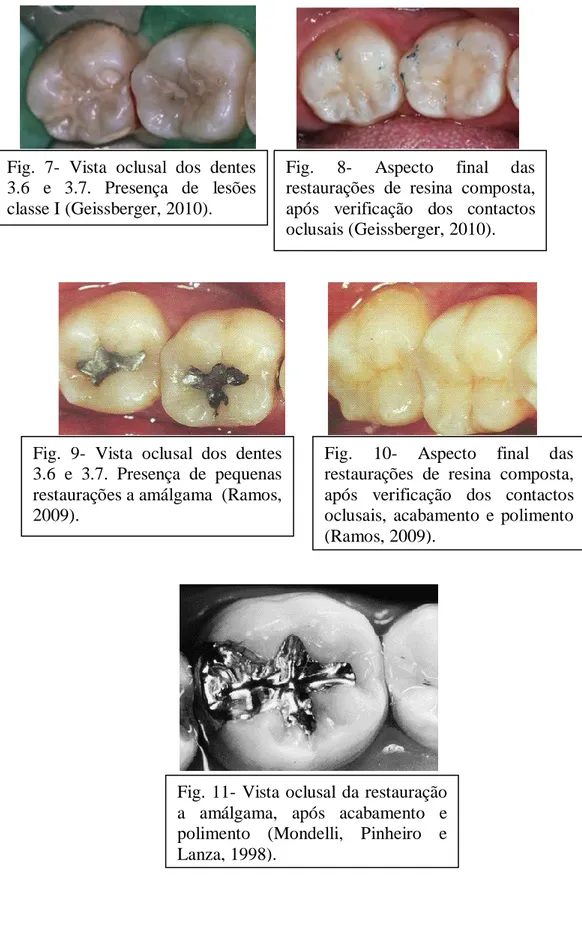 Fig.  7-  Vista  oclusal  dos  dentes  3.6  e  3.7.  Presença  de  lesões  classe I (Geissberger, 2010)
