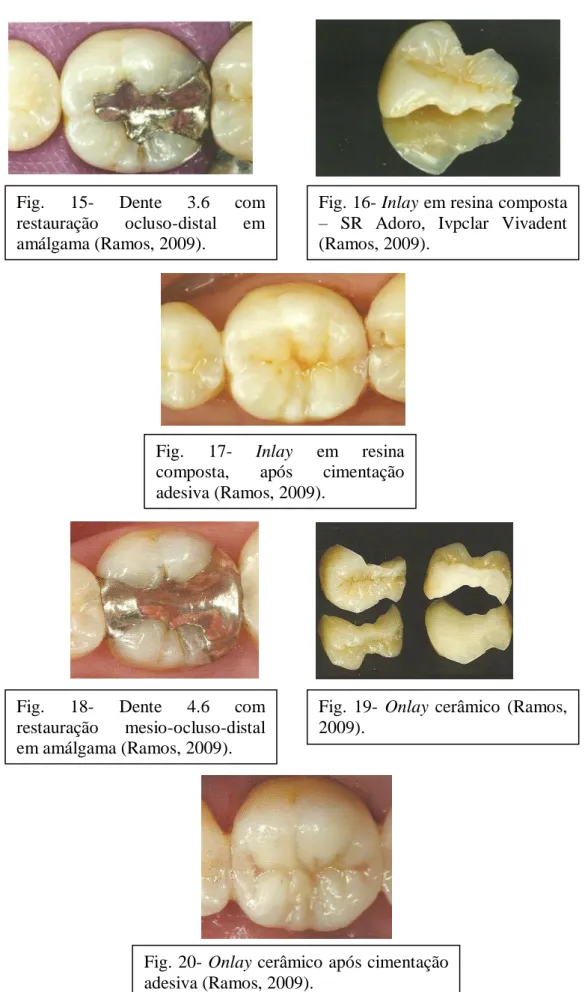 Fig.  15-  Dente  3.6  com  restauração  ocluso-distal  em  amálgama (Ramos, 2009). 