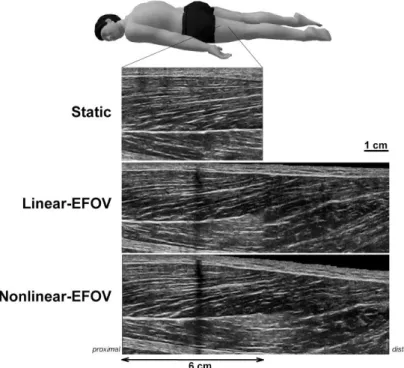 Figure 6. Sonograms of biceps femoris long head from one individual (#13) assessed  at a given region of interest using the three techniques: static-image, linear-EFOV, and  nonlinear-EFOV.