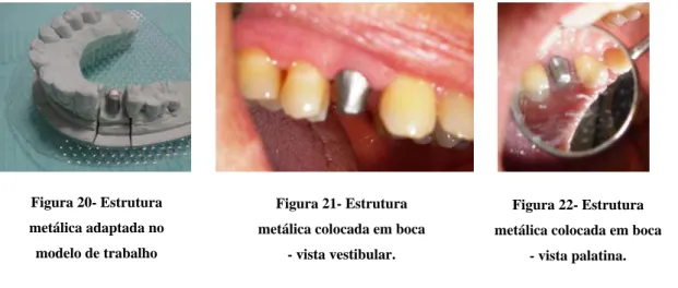 Figura 22- Estrutura  metálica colocada em boca 