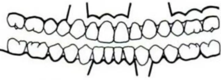 Fig. 9 – Diagrama ilustrativo dos desenhos de retalho mais frequentemente usadas em cirurgia endodôntica