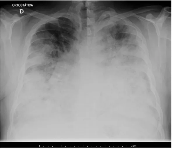FIGURE 1: Chest radiography on admission to the Emergency Department.