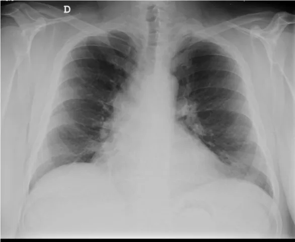 FIGURE 3: Chest radiography during follow-up.
