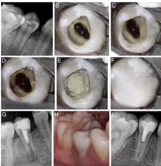 Figura 2. Imagens dos procedimentos endodônticos regenerativos. (A) radiografia periapical de segundo  pré-molar mandibular direito antes do início do tratamento, mostrando cárie oclusal e um ápice imaturo