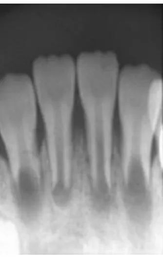 Figura 6: Radiografia da primeira consulta. Incisivos com desenvolvimento radicular incompleto